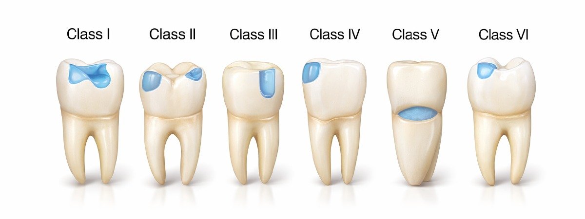 Classifications of dental caries